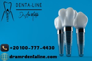 زراعة الأسنان في عيادة دينتل لاين